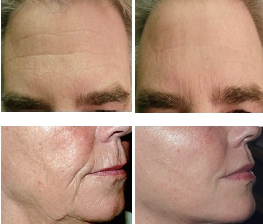 Sanhe Professional Fractional Rf Microneedl Face Treatment With 2Mhz RF Sanhe Professional Fractional Rf Microneedl Face Treatment With 2Mhz RF