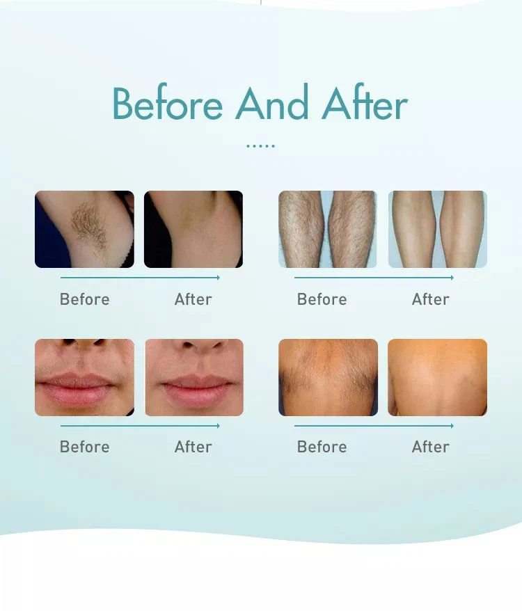 diode laser hair removal manufacturers