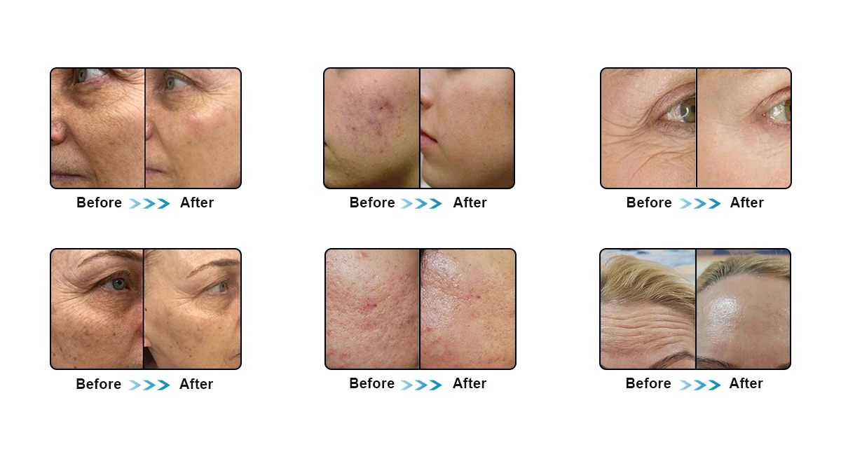 Vacuum Microneedle Rf Machine Vacuum Microneedle Rf Machine