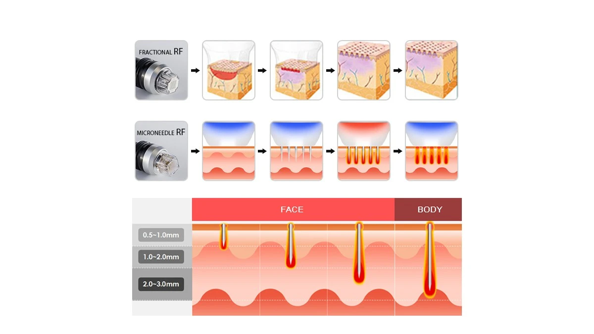 Microneedle RF